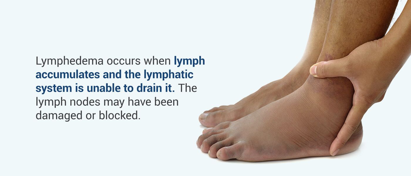 Primary Vs Secondary Lymphedema Symptoms Causes And Treatment